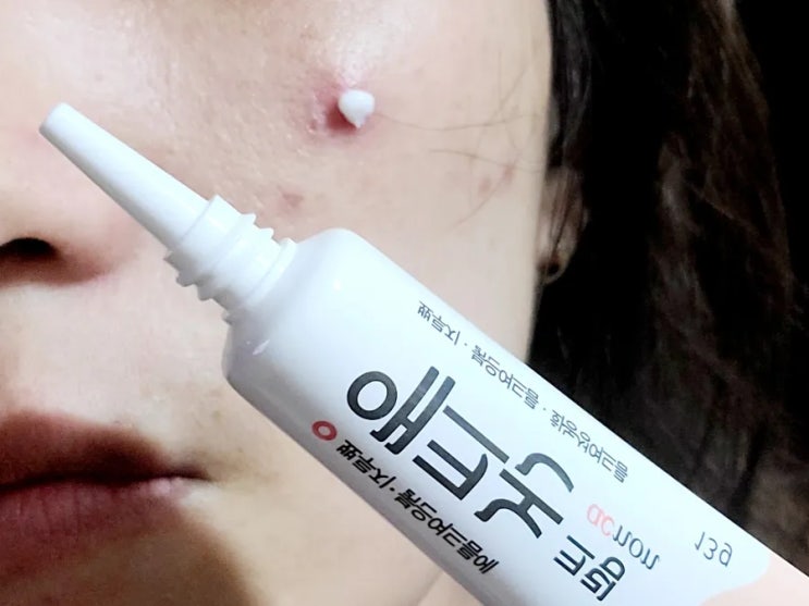  애크논 크림 가격 붉고 아픈 여드름 뾰루지에 발라요!