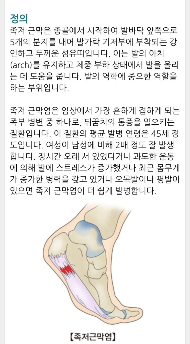  족저근막염 스트레칭