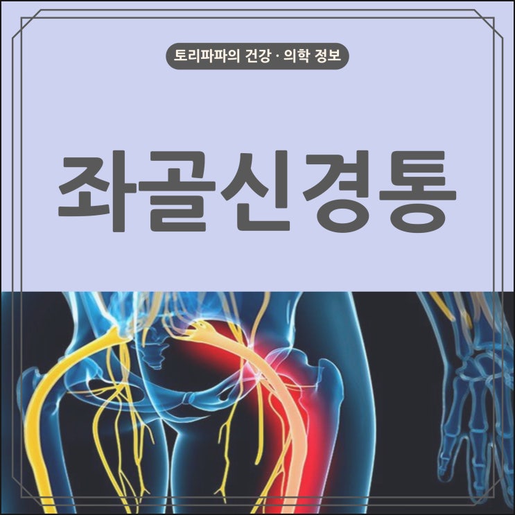 엉덩이와 다리 쪽에 찌릿한 통증이 발생하는 좌골신경통(Sciatica)의 원인 및 증상, 치료