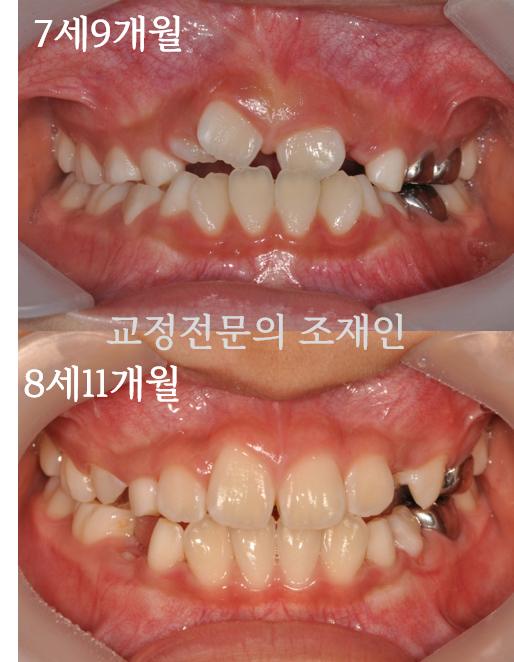  어린이 반대교합의 치료, 치아의 문제, 가철식 확장장치