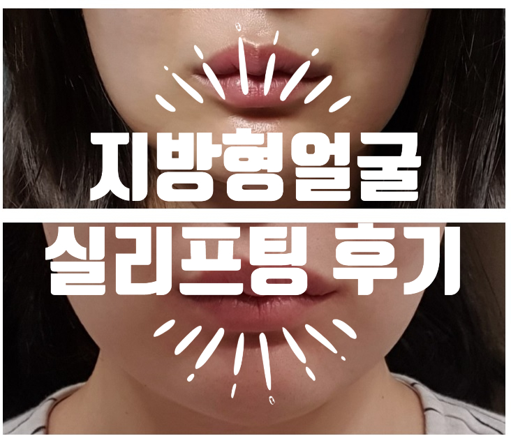  실리프팅 으로 심부볼 & 팔자주름 없애기 시도해봄