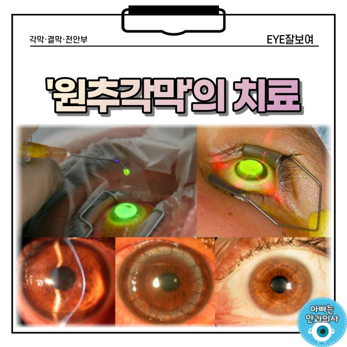  '원추각막' - 치료는 어떻게?