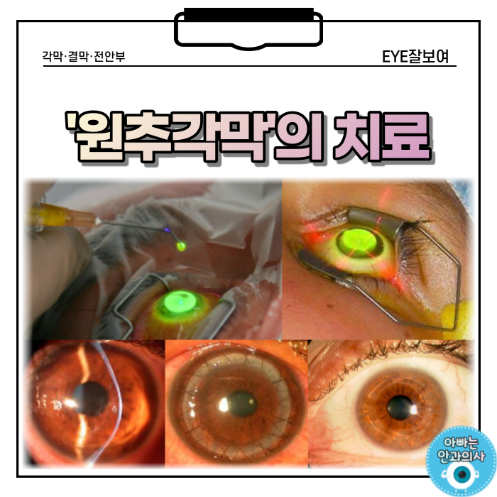 '원추각막' - 치료는 어떻게?