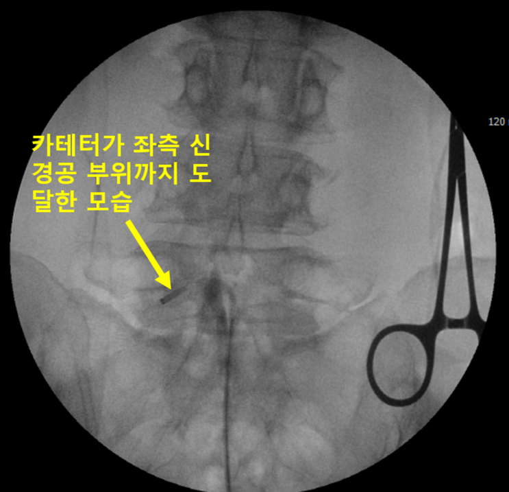  10번 넘게 신경주사로 호전이 없던 요추협착증 시술 증례