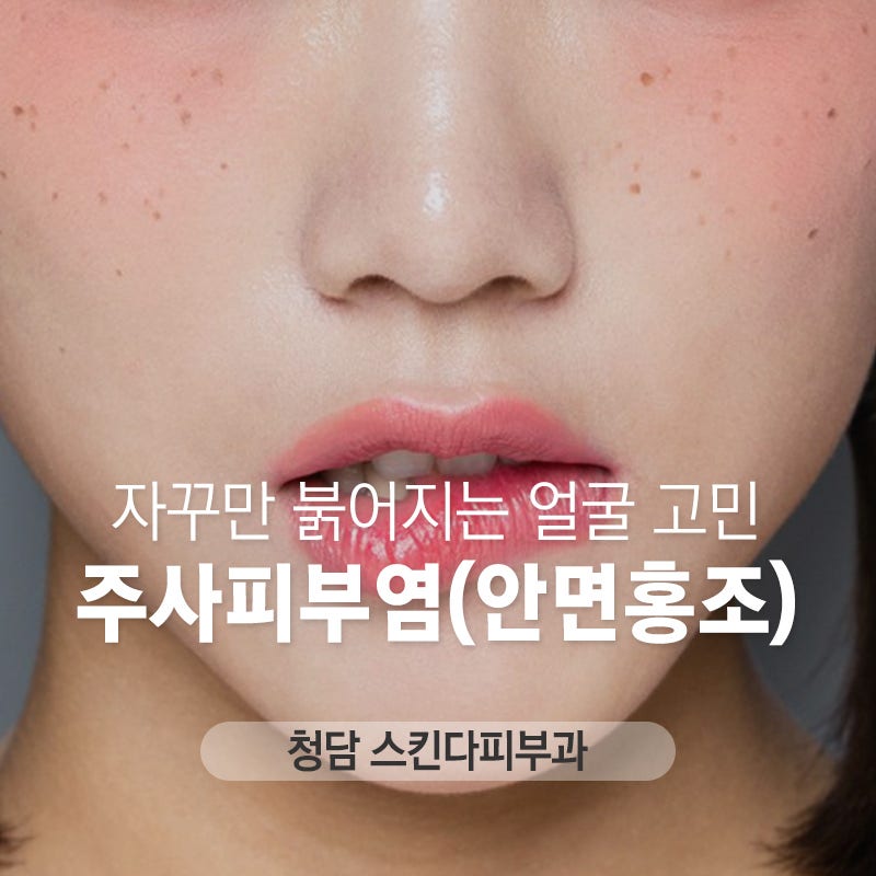 안면홍조 원인에 따른 레이저 11