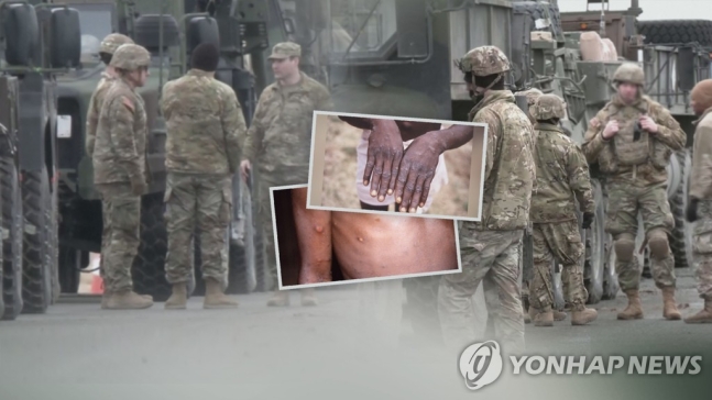 국내 첫 원숭이두창 감염 의심자 2명 발생…"진단검사 진행중" 국내 첫 원숭이두창 감염 의심자 2명 발생…"진단검사 진행중"