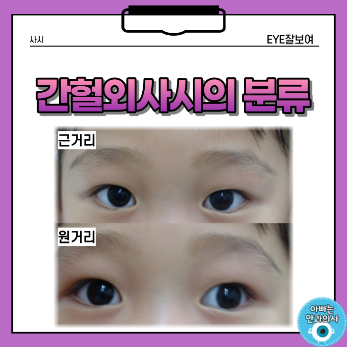 간헐외사시의 분류와 검사방법 - 간헐적 외사시의 종류, 감별