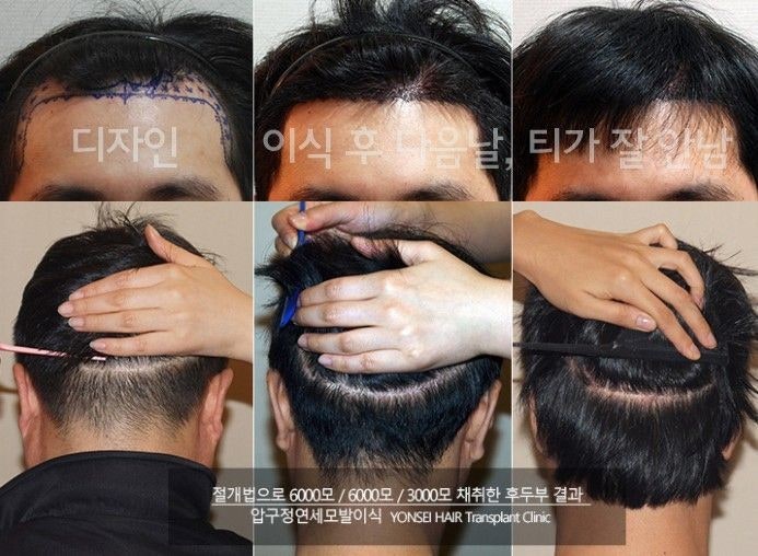 모발이식수술에 있어서 가격, 서비스보다 더 중요한 것! 8