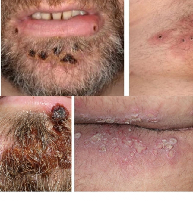 원숭이두창, 주로 성소수자 감염? 전문가 답변 들어보니 원숭이두창, 주로 성소수자 감염? 전문가 답변 들어보니