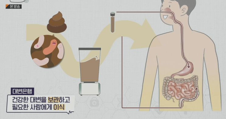 대변이식해야할까