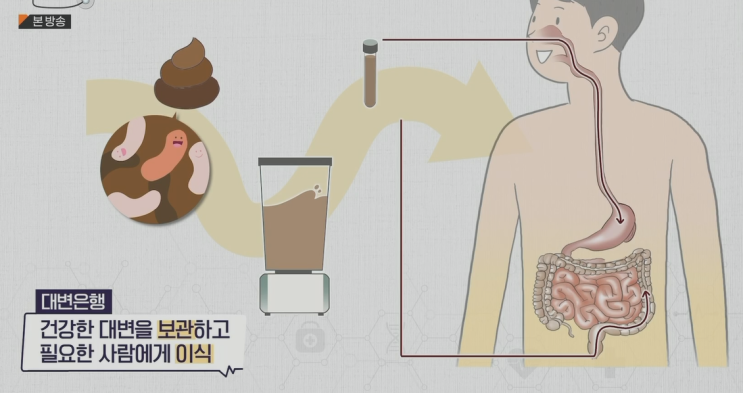 대변이식해야할까