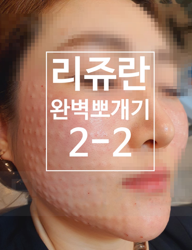  리쥬란!이렇게 맞는게 수학의 정석(feat.이젠 내가 리쥬란 박사,주사방법,부작용,통증,엠보싱, 리쥬란 힐러 완벽 뽀개기 2-2)