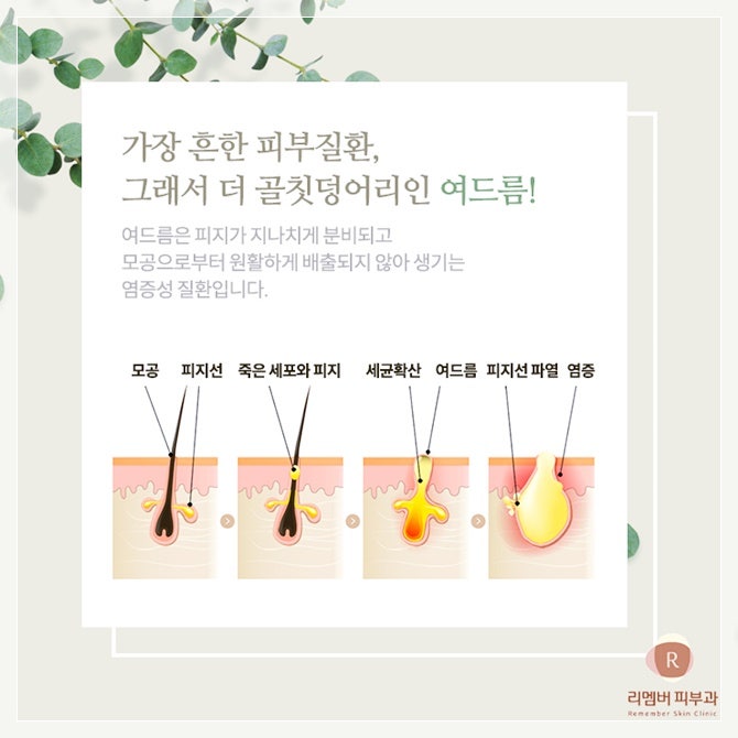 이천피부과 여드름관리부터 2