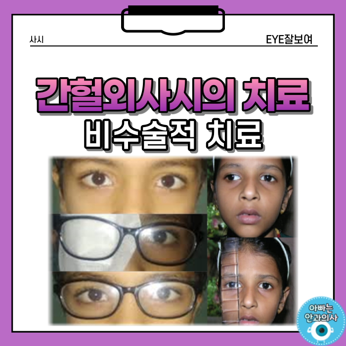  간헐외사시의 비수술적 치료