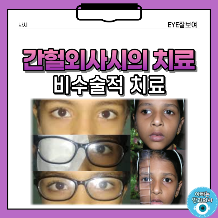 간헐외사시의 비수술적 치료