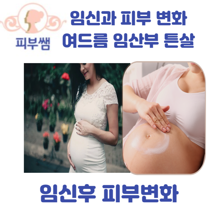 임신과 피부 변화 여드름 임산부 튼살
