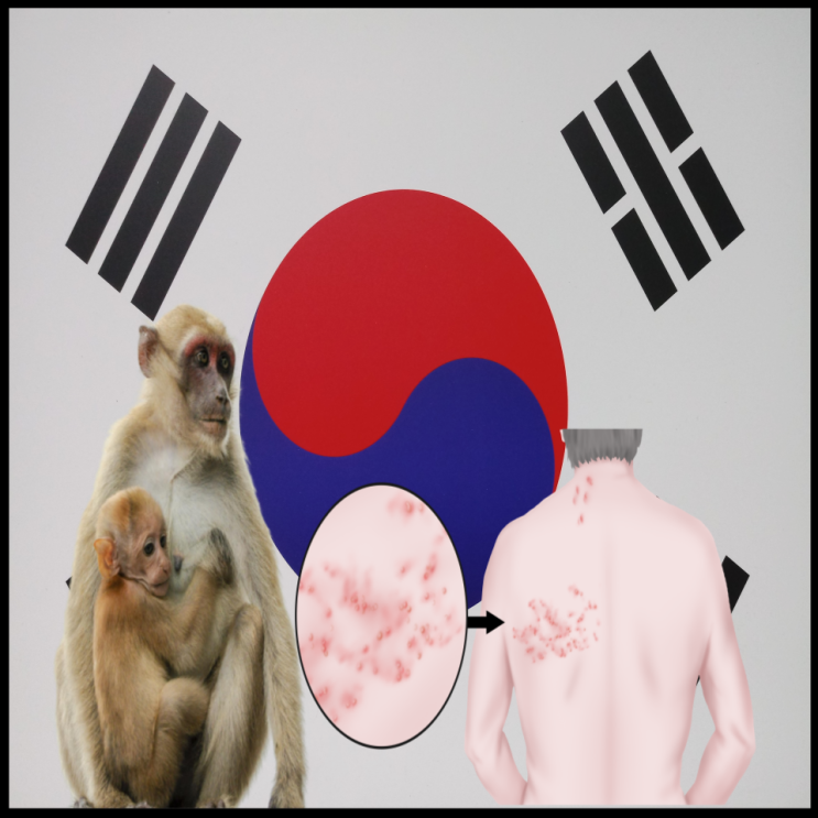 한국 원숭이두창 확진자, 원인 증상 알아보기