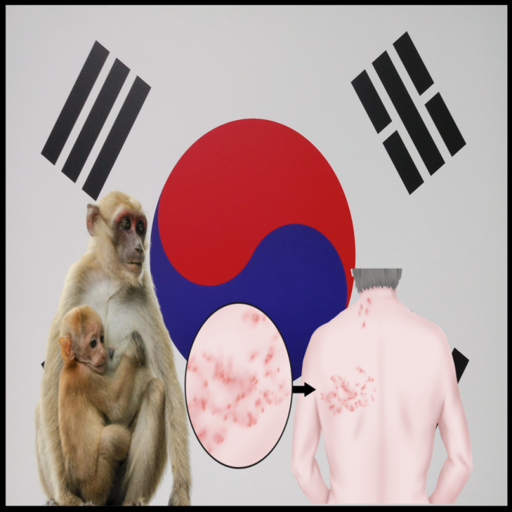  한국 원숭이두창 확진자, 원인 증상 알아보기