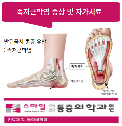  [발뒤꿈치통증] 족저근막염 원인 및 증상, 예방.스트레칭법