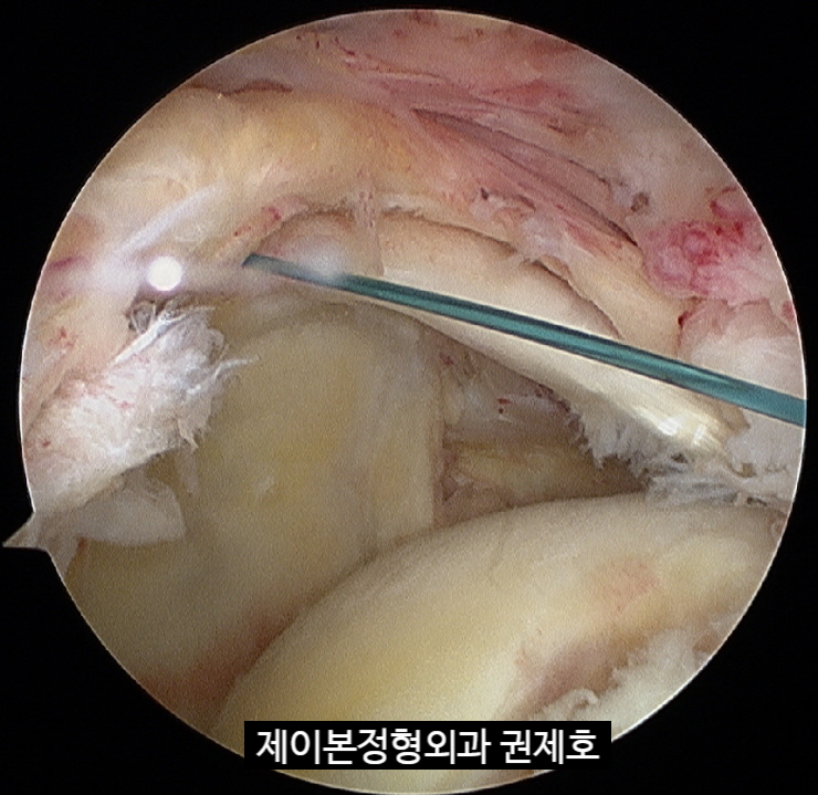 넘어진 후 발생한 외상성 회전근개파열로 시행한 관절경 회전근개 이중봉합술 / 제이본정형외과 권제호