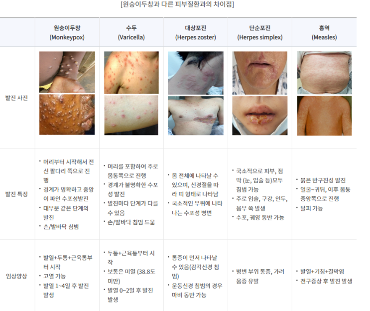  원숭이 두창/ 수두/ 예방하고/ 자료로 쓰자
