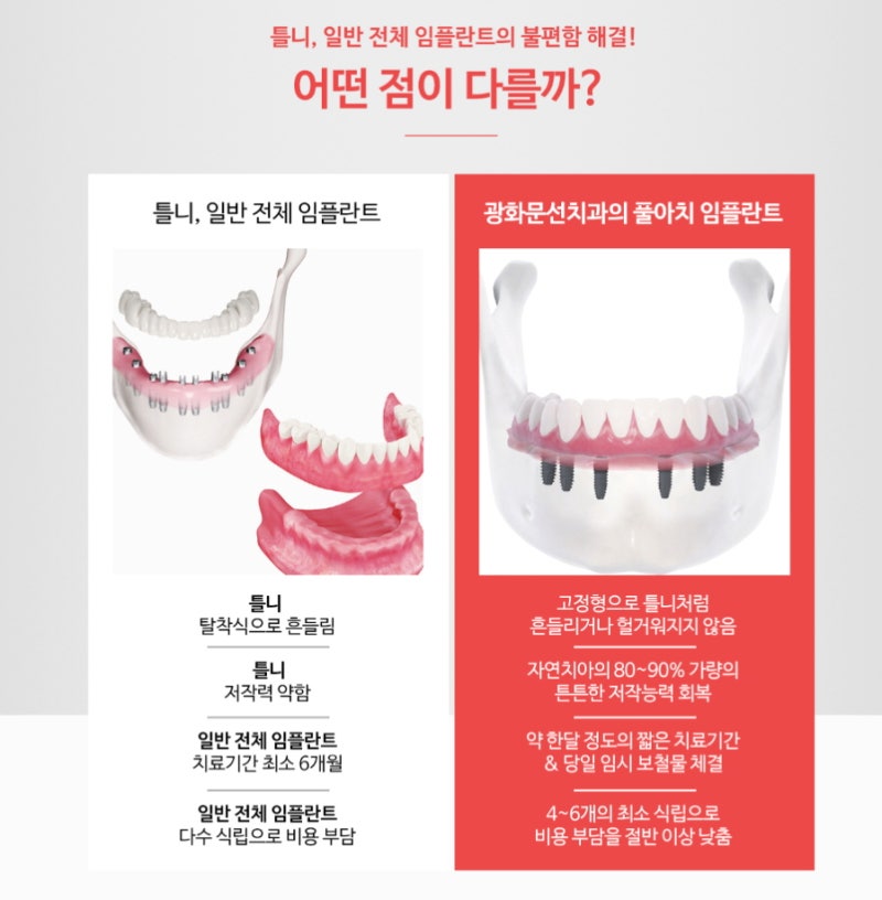 전체임플란트 최소 식립으로 비용