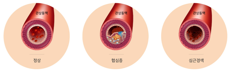 동맥경화증, 합병증으로 이어지지