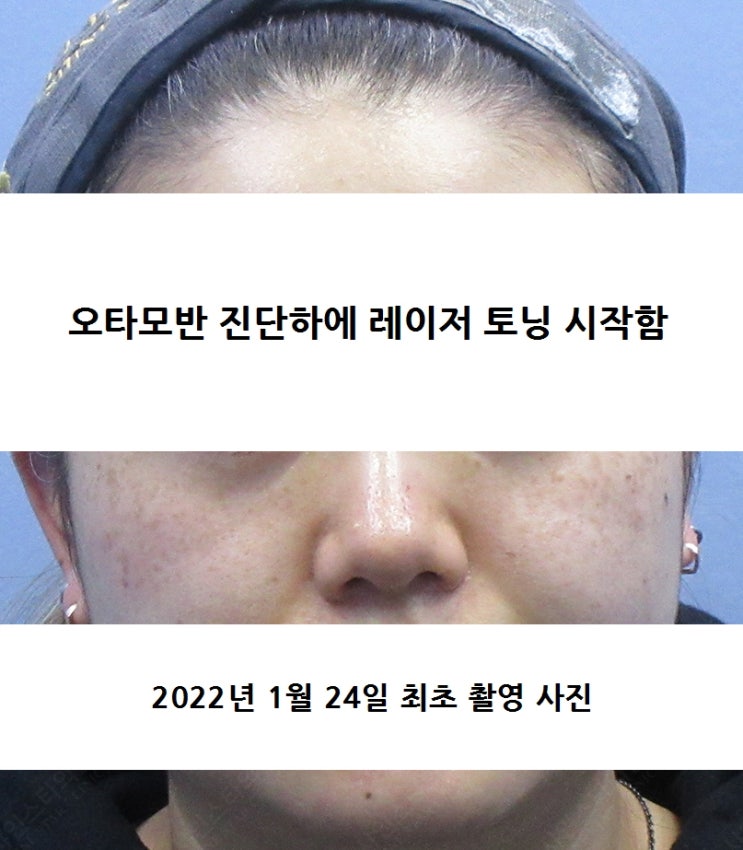  오타모반 고객님 A 레이저 토닝 치료 시술일기 Ep.1(시술일기 intro 포스팅)