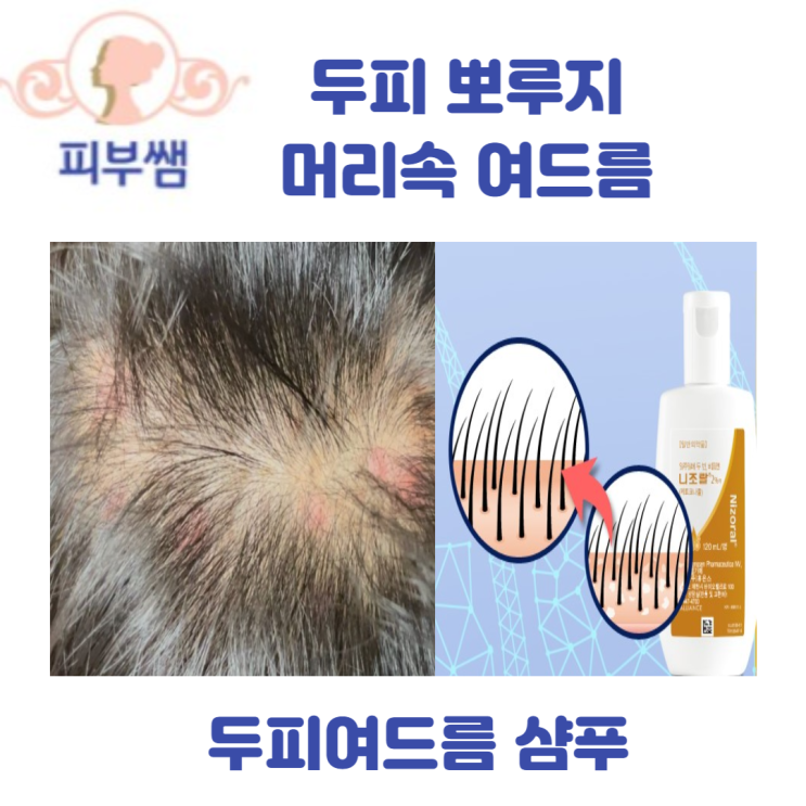  두피 뽀루지 머리속 여드름  두피여드름 샴푸