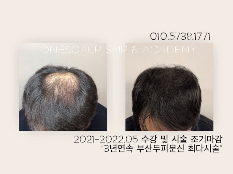 부산남자정수리두피문신도 전문기관 원스칼프에서?
