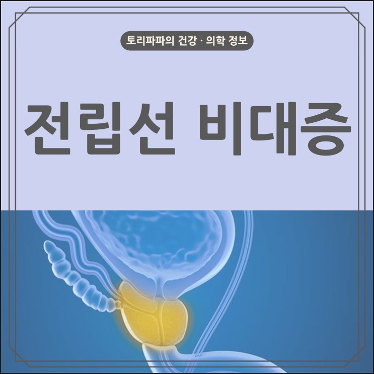  남성들의 말 못 할 고민 전립선 비대증의 원인 및 증상, 치료(의학용어 BPH)