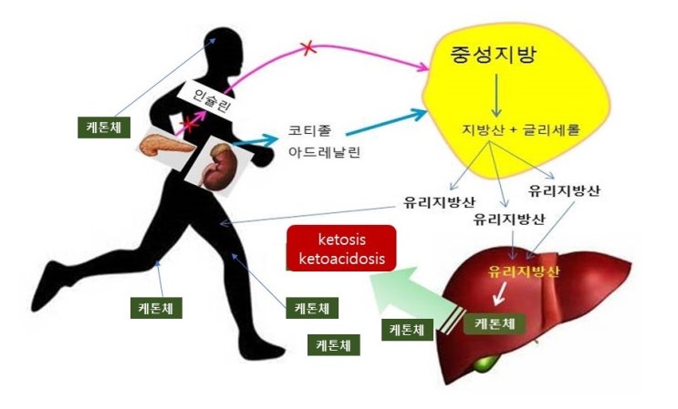  제1형 당뇨환자가 아침 식전운동을 피하여야 하는 이유, 케톤산증(ketoacidosis)