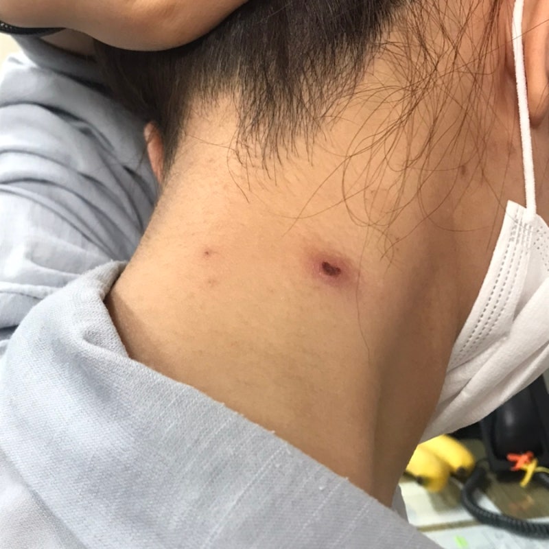 관악이비인후과의원 림프선염으로 방문후기(feat.조직검사,혈액검사,끼움판매)