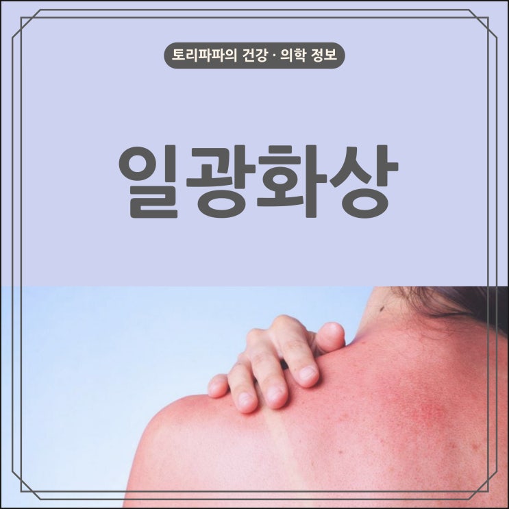  휴가철, 자외선으로 인한 일광화상(햇빛 화상)의 원인 및 증상, 치료, 예방 방법