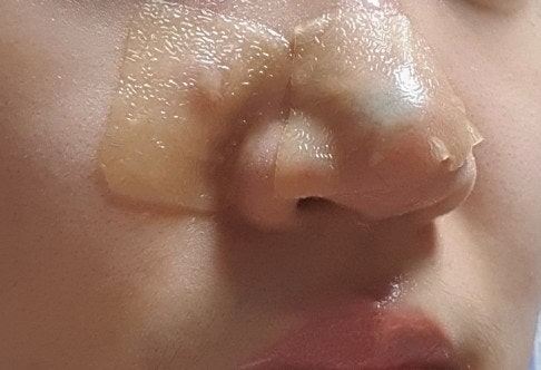  얼굴대상포진 치료기② - (6.3~6.24) 코 대상포진 피부사진/통증/세수/회복/비용/흉터/청력검사