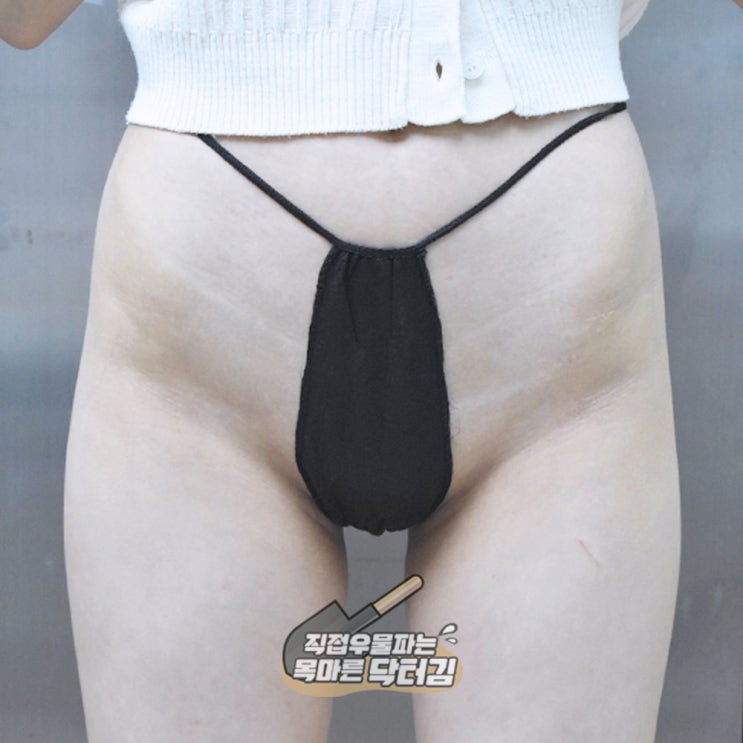  생생한 골반필러후기! 힙딥은 없지만 뭔가 아쉬운데... 말로 설명할 수는 없고... 근데 마음에는 안 들고...