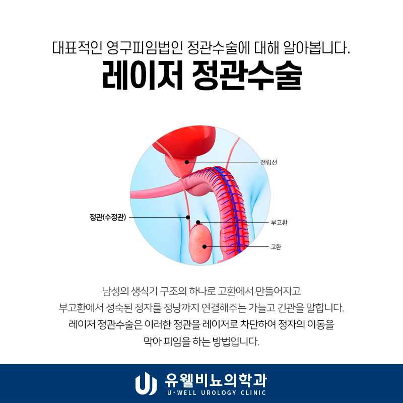 대전정관수술 효율적이고 효과적인 방법