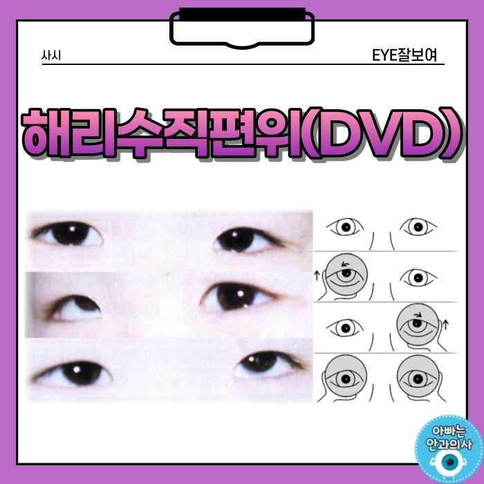 피곤하고, 멍때릴 때 눈이 올라가요 - '해리수직편위(DVD)'란?