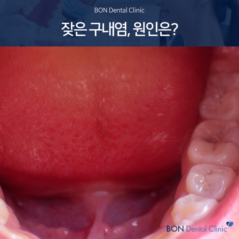 혀밑구내염 돌기로 인한 따끔함 원인은? : 네이버 블로그