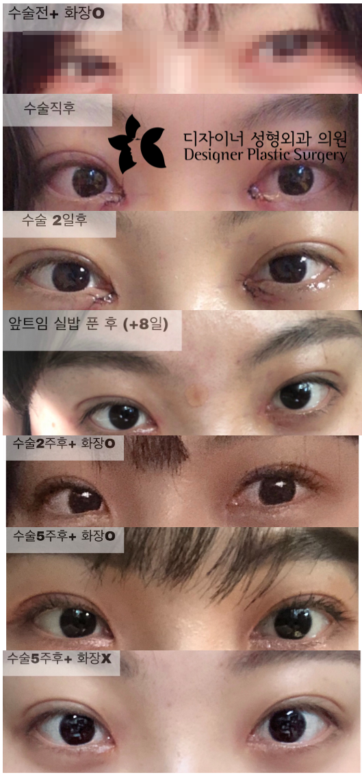 눈성형외과 추천 안검하수를 겪고 있을 때