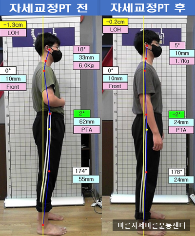 [서래마을PT]굽은등 교정,거북목교정,키성장,옆모습바른자세 비포애프터