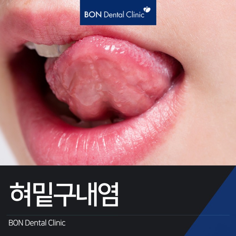 혀밑구내염 돌기로 인한 따끔함 원인은? : 네이버 블로그
