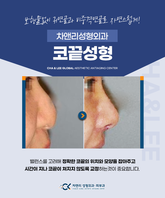  코끝쳐짐엔 차앤리 무보형물 코끝성형