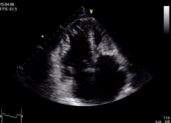 Tricuspid annular plane systolic excursion (TAPSE) - RV function 평가 ...