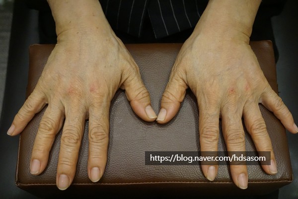 손등 필러로 마른 손 개선 - 삼성동 피부과전문의 닥터림