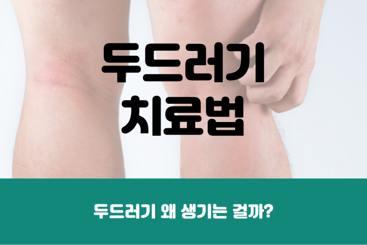  두드러기 왜 생기는 걸까? 두드러기 치료법