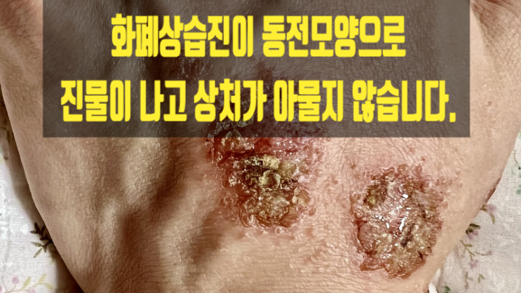  화폐상습진이 동전모양으로 진물이 나고 상처가 아물지 않습니다.