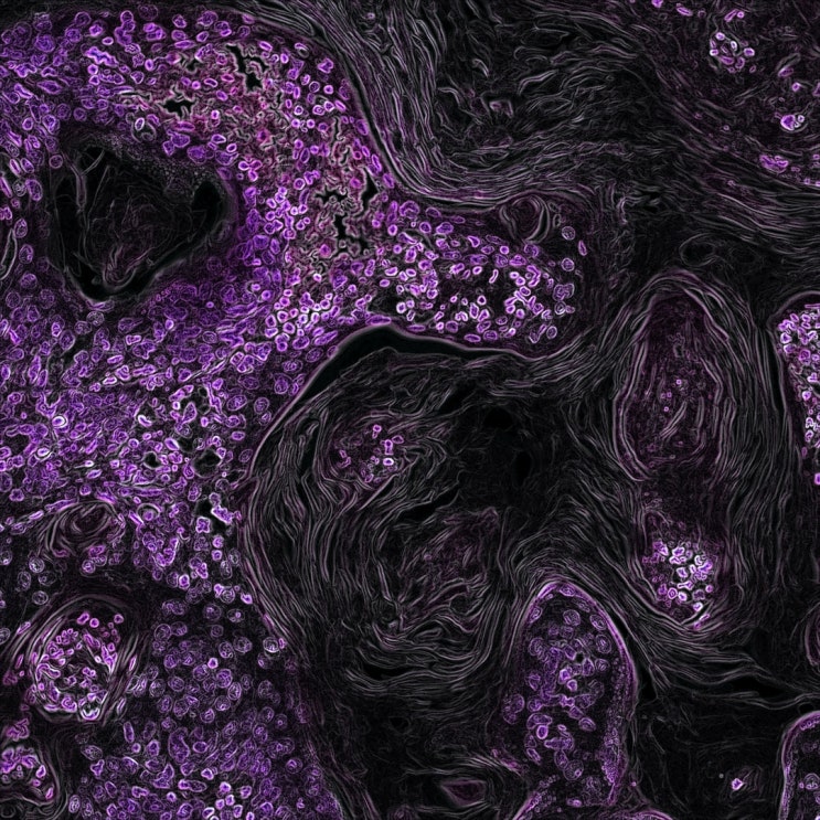  바이러스성 세균성 폐렴의 증상과 원인 Streptococcus pyogenes,SARS