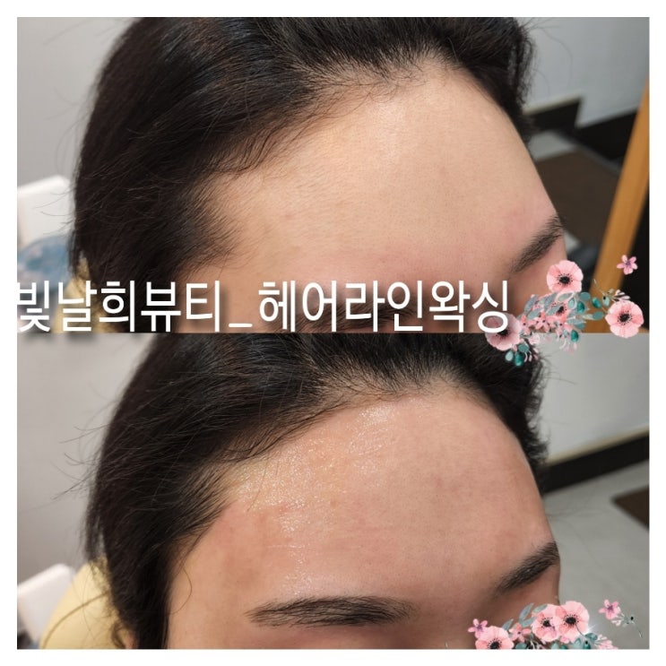  깔끔한 이마라인으로 필러효과보기 빛날희왁싱에서 헤어라인왁싱추천