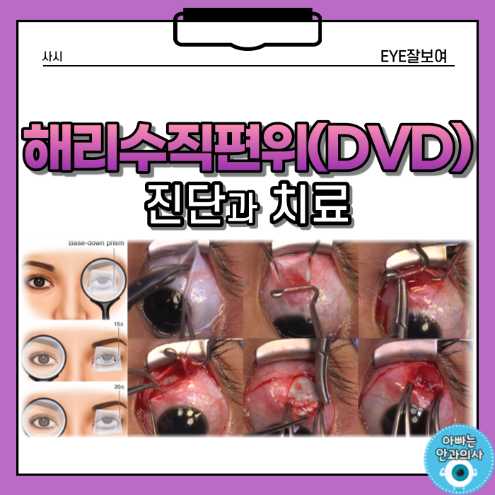 해리수직편위(DVD)의 진단, 치료